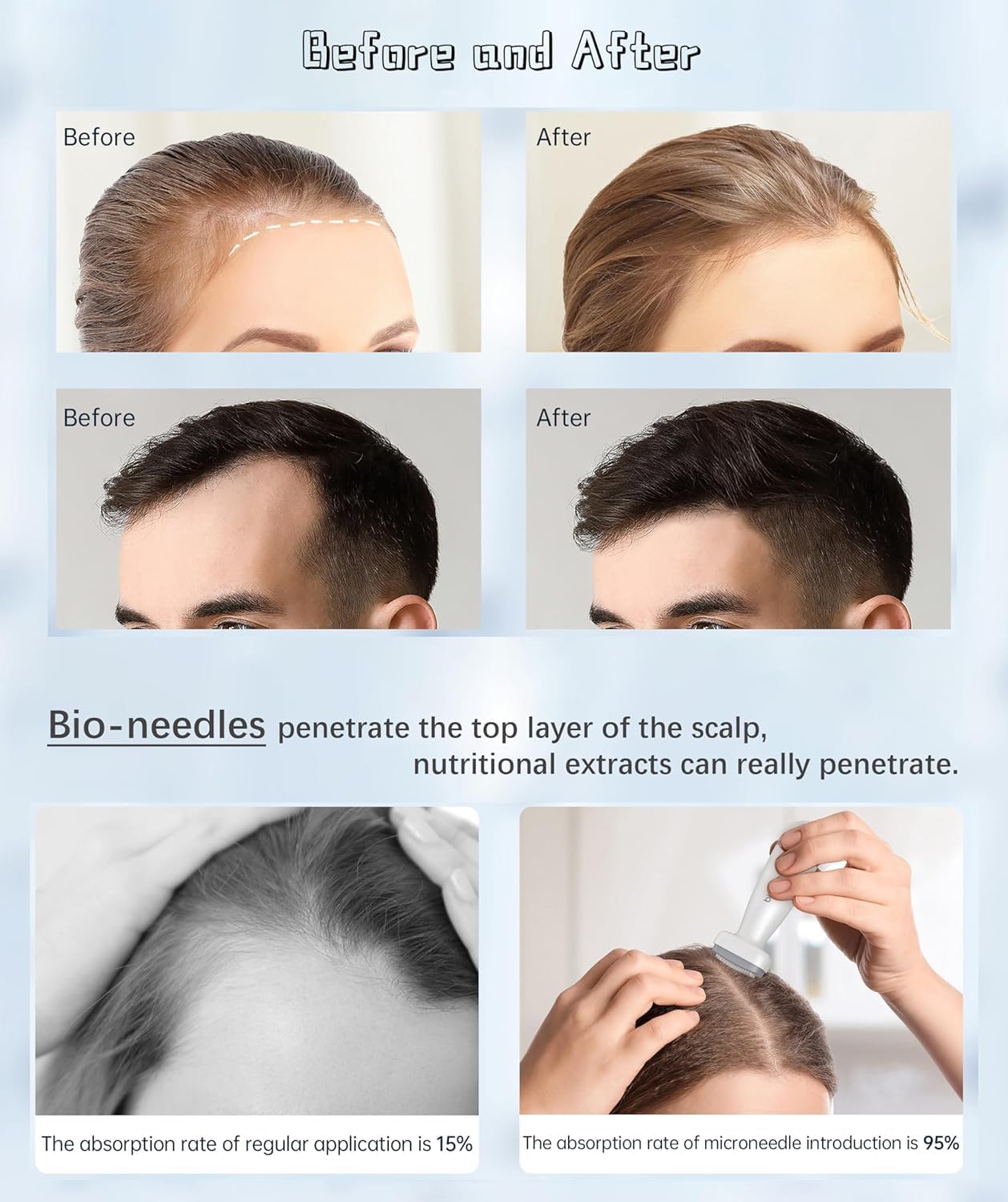 Dr. Pen BioNeedle™ Adjustable Micro-needling Derma Stamp